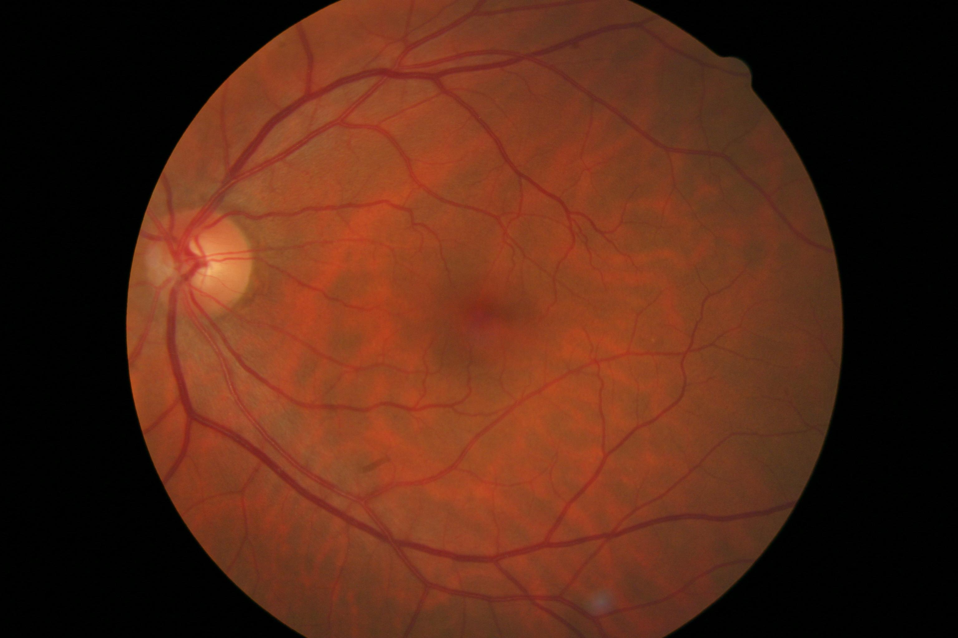 Alzheimer diagnosis using fundus images